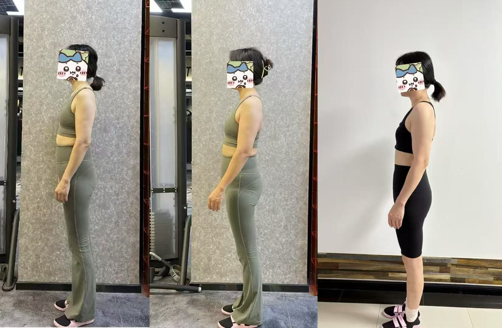 腰间盘突出学员一年力量训练后的侧面阶段对比